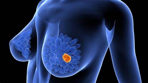 Quindío y Risaralda, entre los territorios con más reportes de cáncer de mama